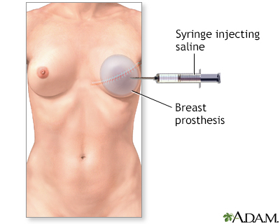 images of breast. Breast reconstruction