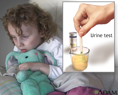 Urine test for ketoacidosis