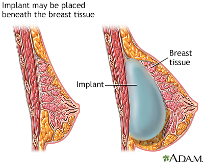 images of breast. Breast augmentation