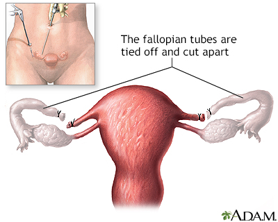 Tubal ligation - series - Baptist Hospital East Tubal ligation - series - Baptist Hospital East