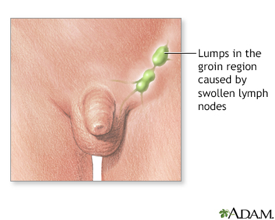 Swollen lymph nodes in the